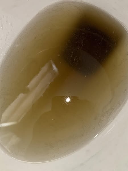 Det farligaste tecknet på njurskador är inte vad du tror