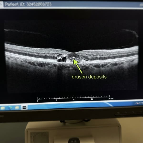 They Offered Surgery. Nobody Mentioned the Starving Nerve.