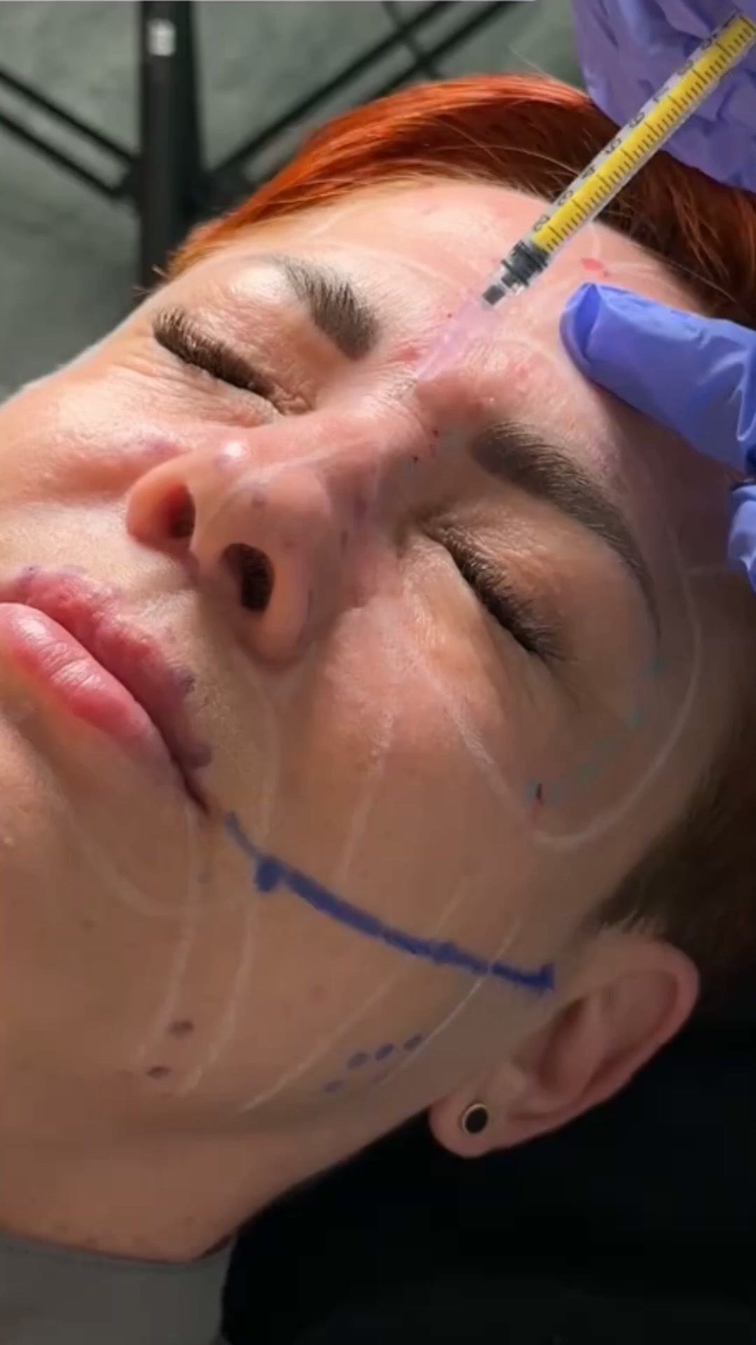 MASTER BOTULINUM TOXIN