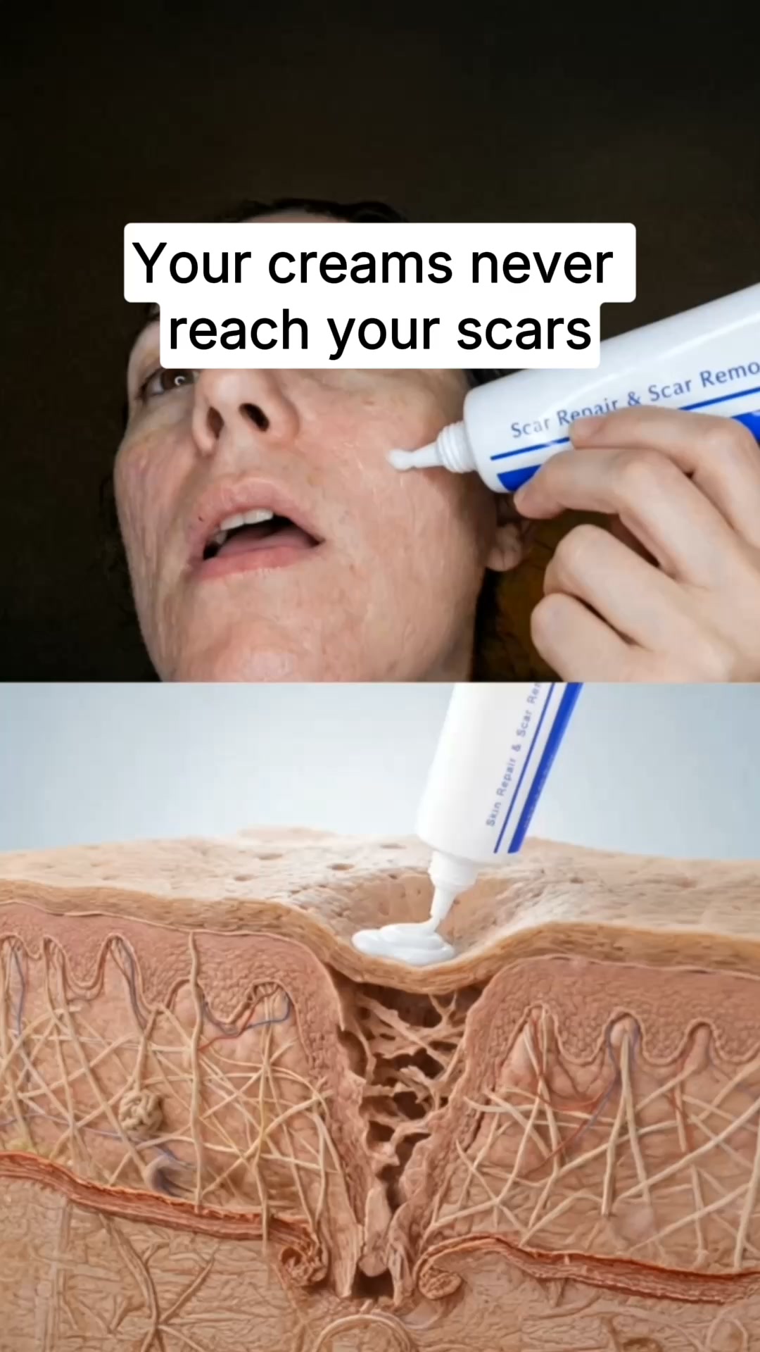 The Salmon DNA Hack Repair For Acne Scars
