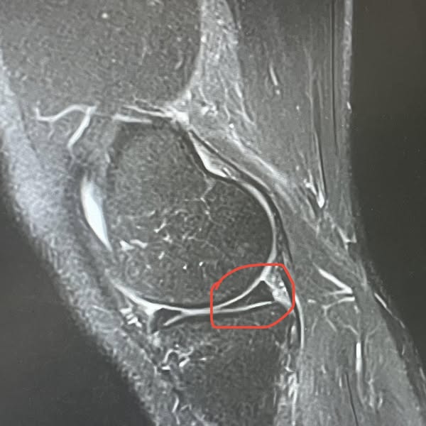 Read This If Your Getting Knee Surgery