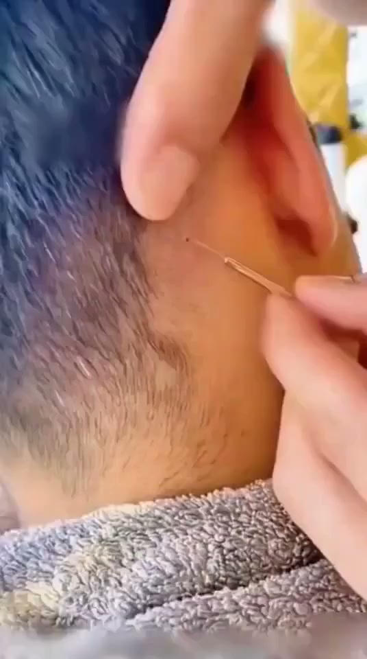 Professional Facial Blackhead Remover Tweezers