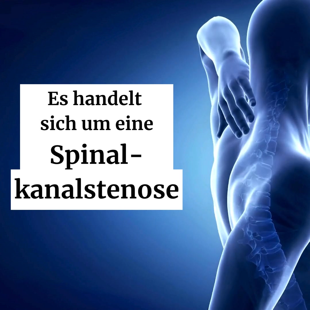 Spinalkanalstenose?
