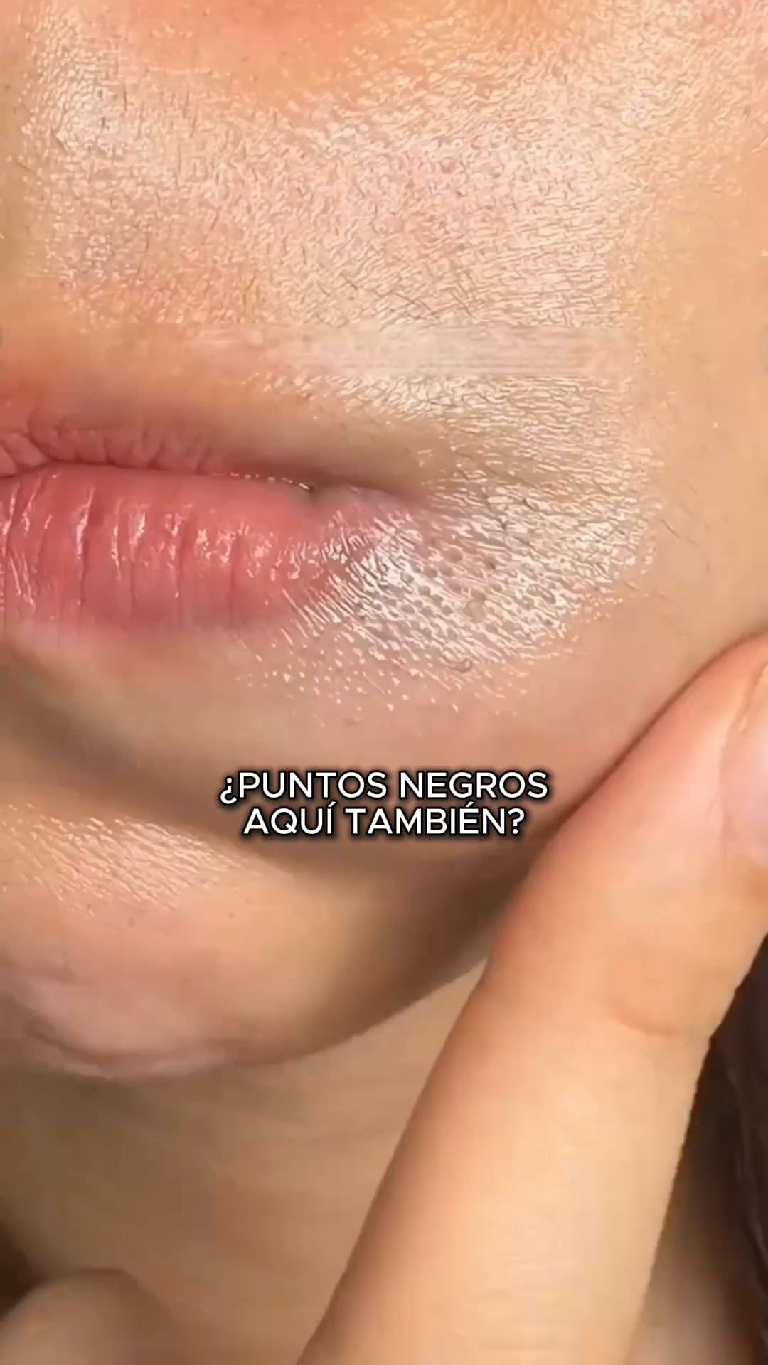 Adiós puntos negros - Sin tiras