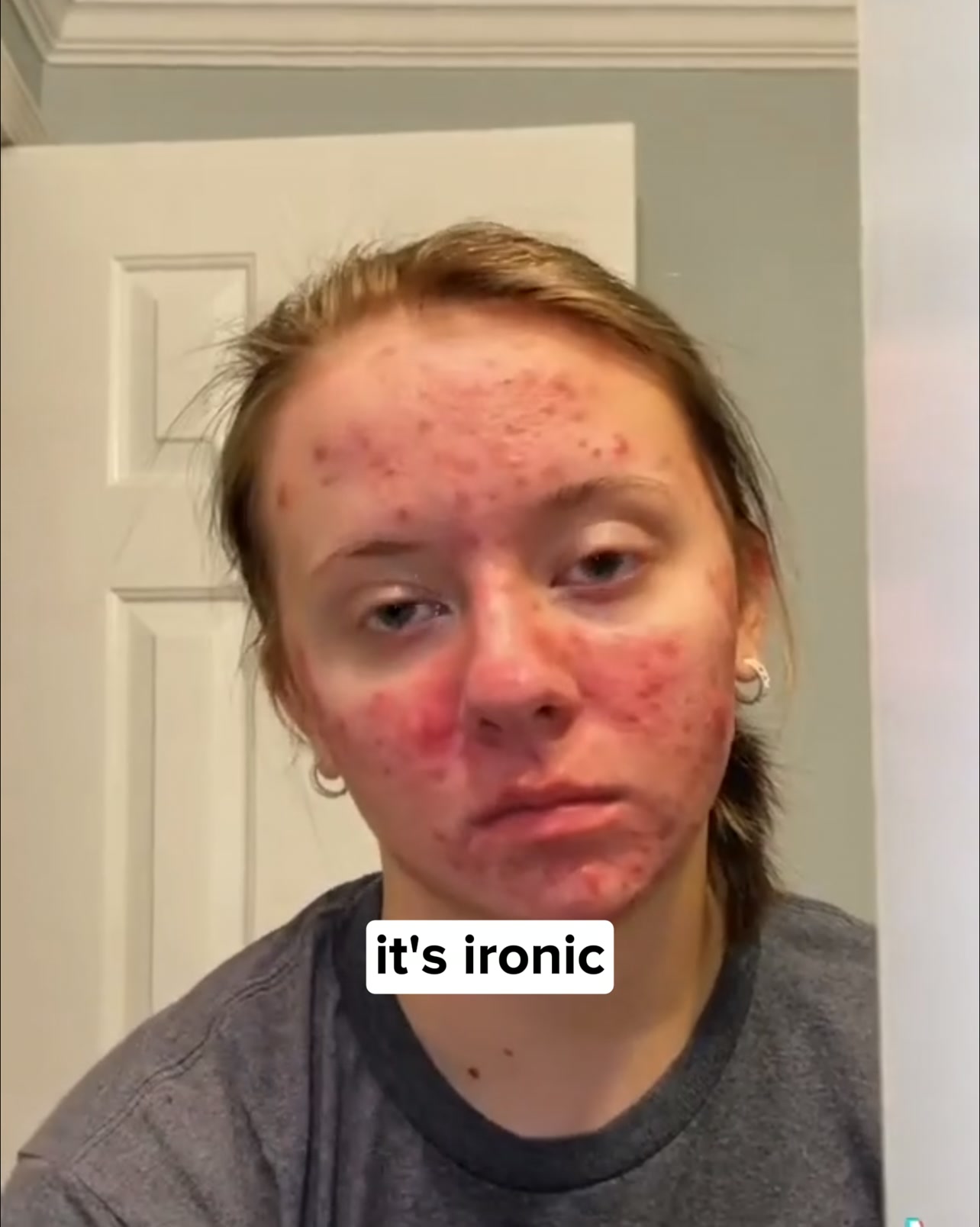 Stop acne now!