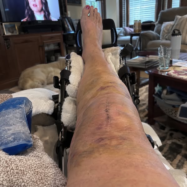 Read If Knee Pain After Replacement