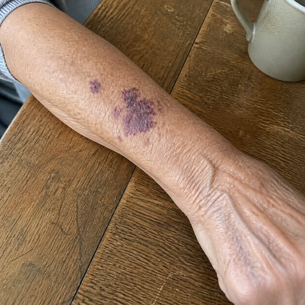 Why These Purple Marks Appear After 65