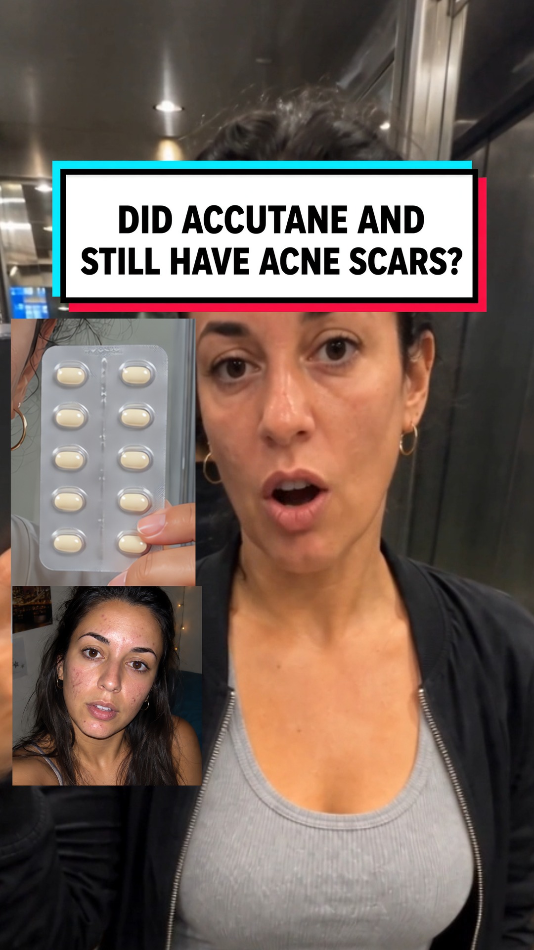 Accutane Cleared My Acne. Not My Scars.