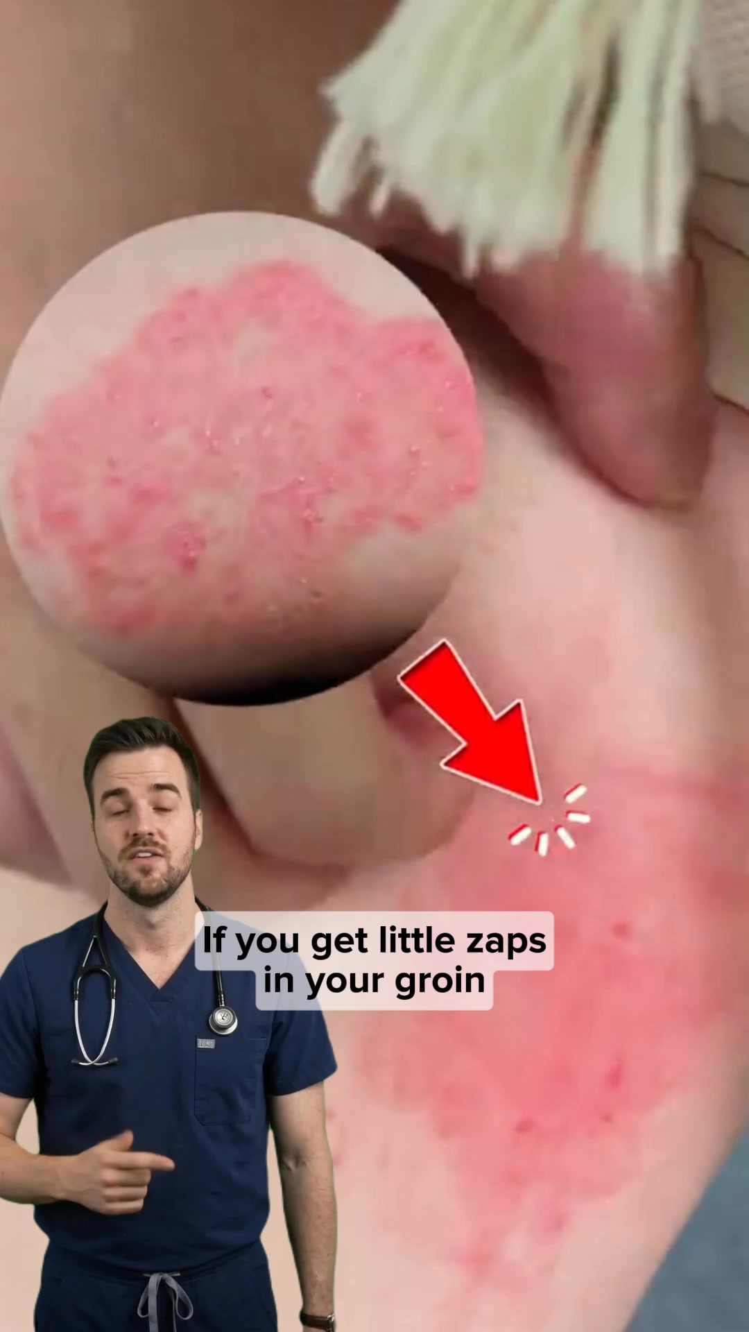 Why Your Jock Itch Keeps Coming Back