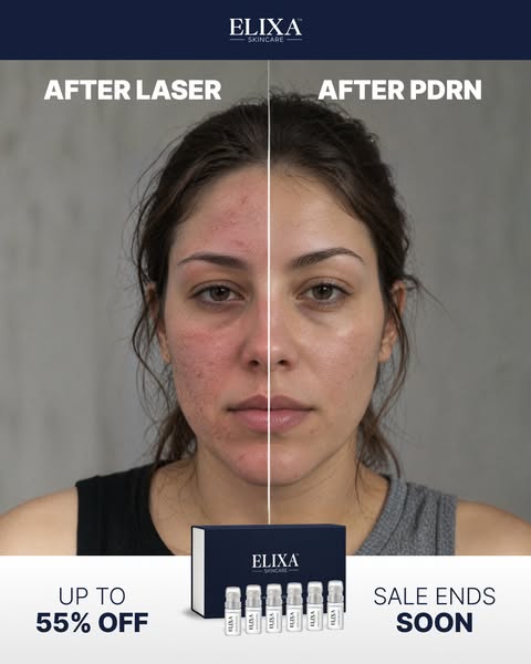 What PDRN Does for Your Acne Scars
