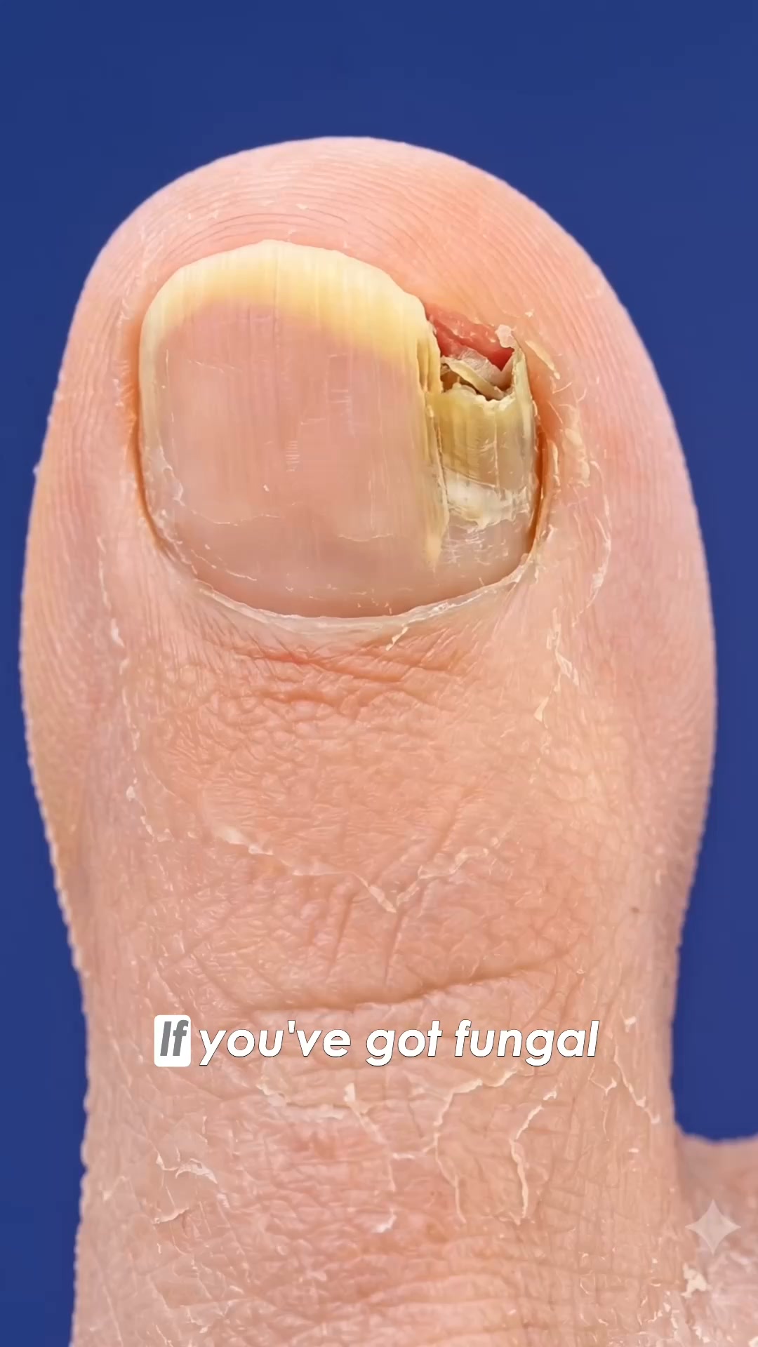 Fungal Nails? Find The Cause