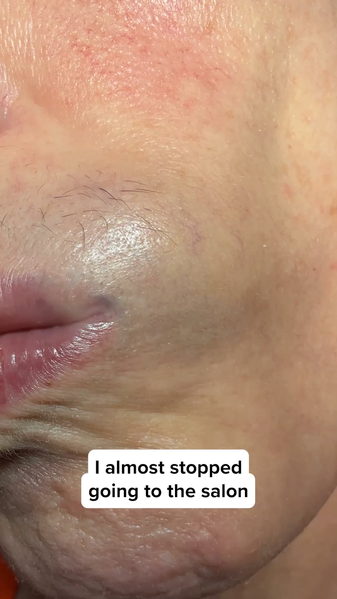 Dermaplaning, Made Effortless