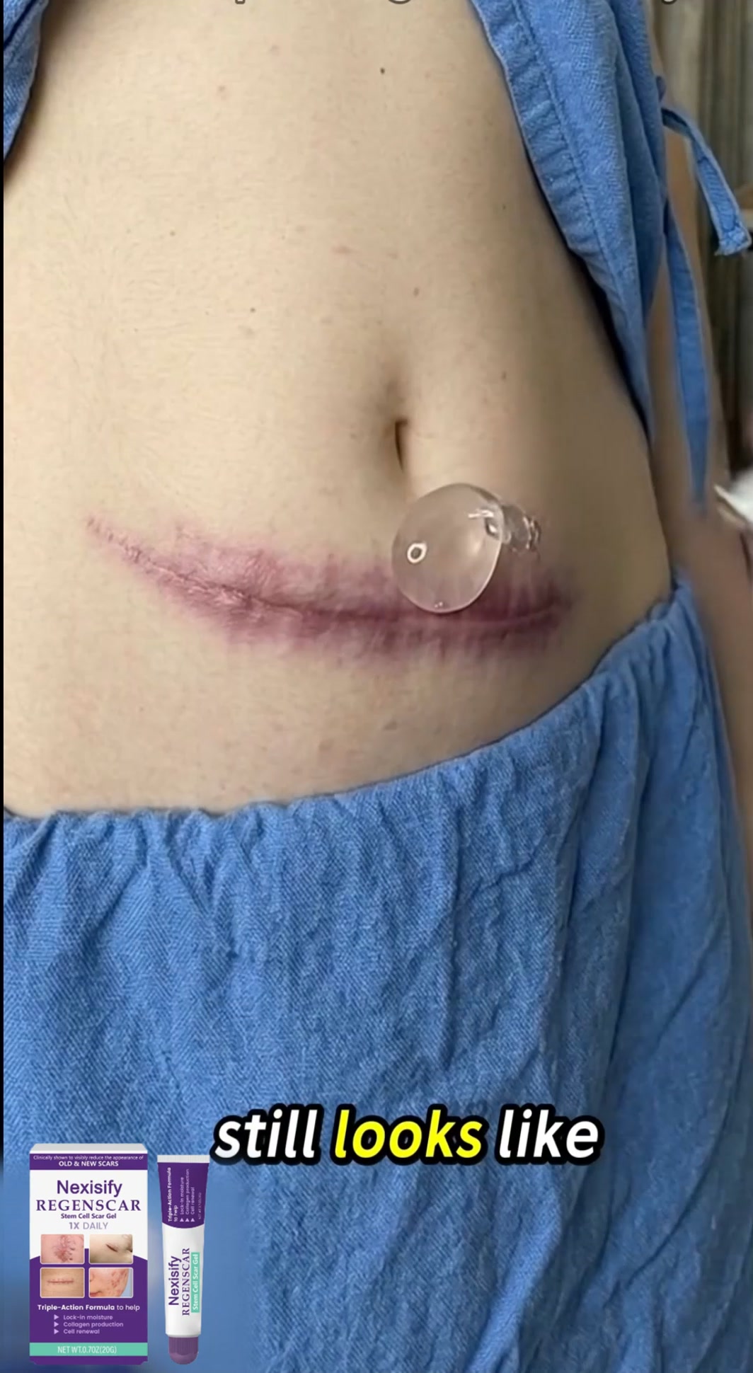 Say Goodbye to Stubborn Old & New Scars