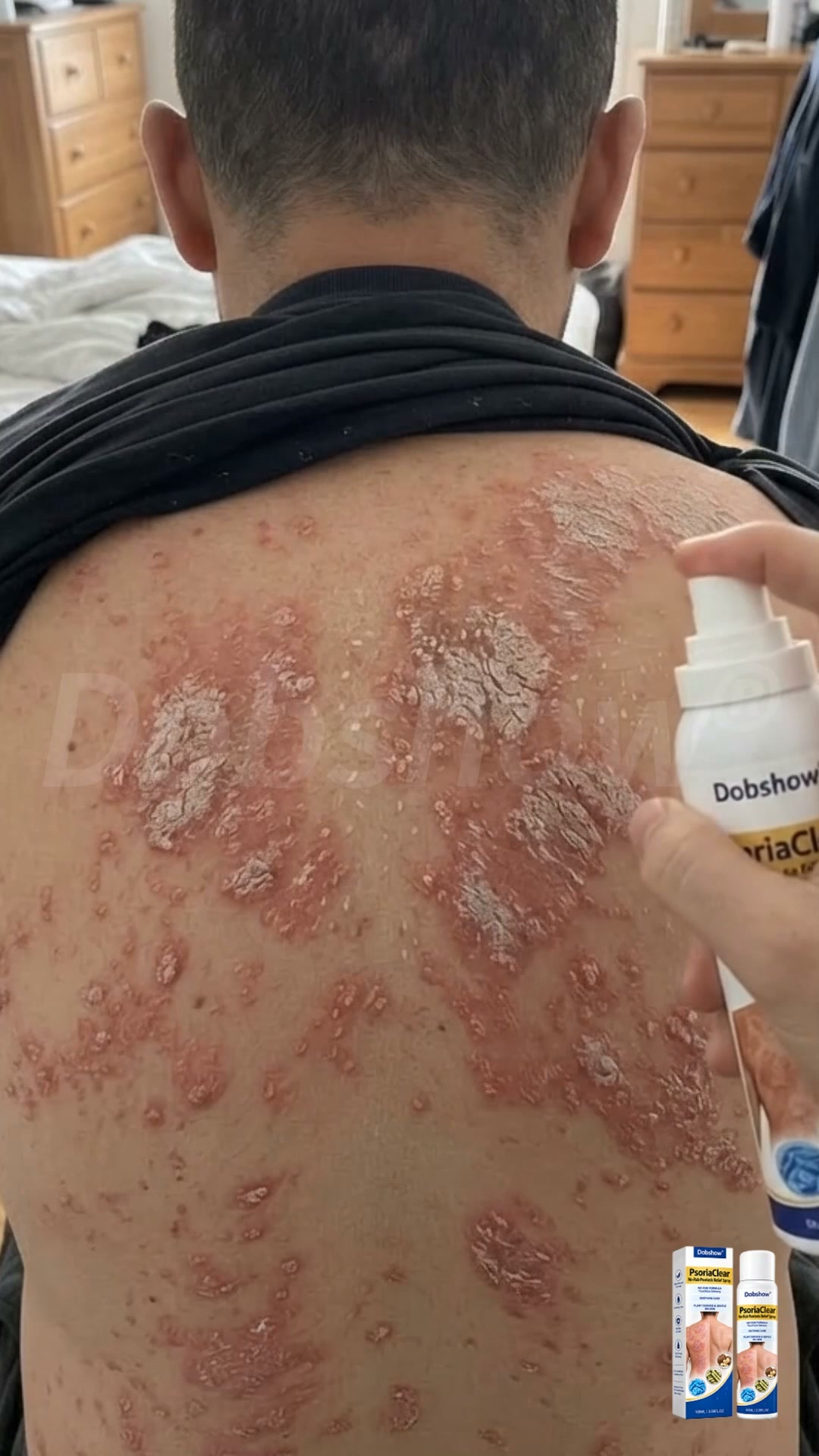 BREAKTHROUGH: Why rubbing thick creams into psoriasis plaques is doing more harm than good