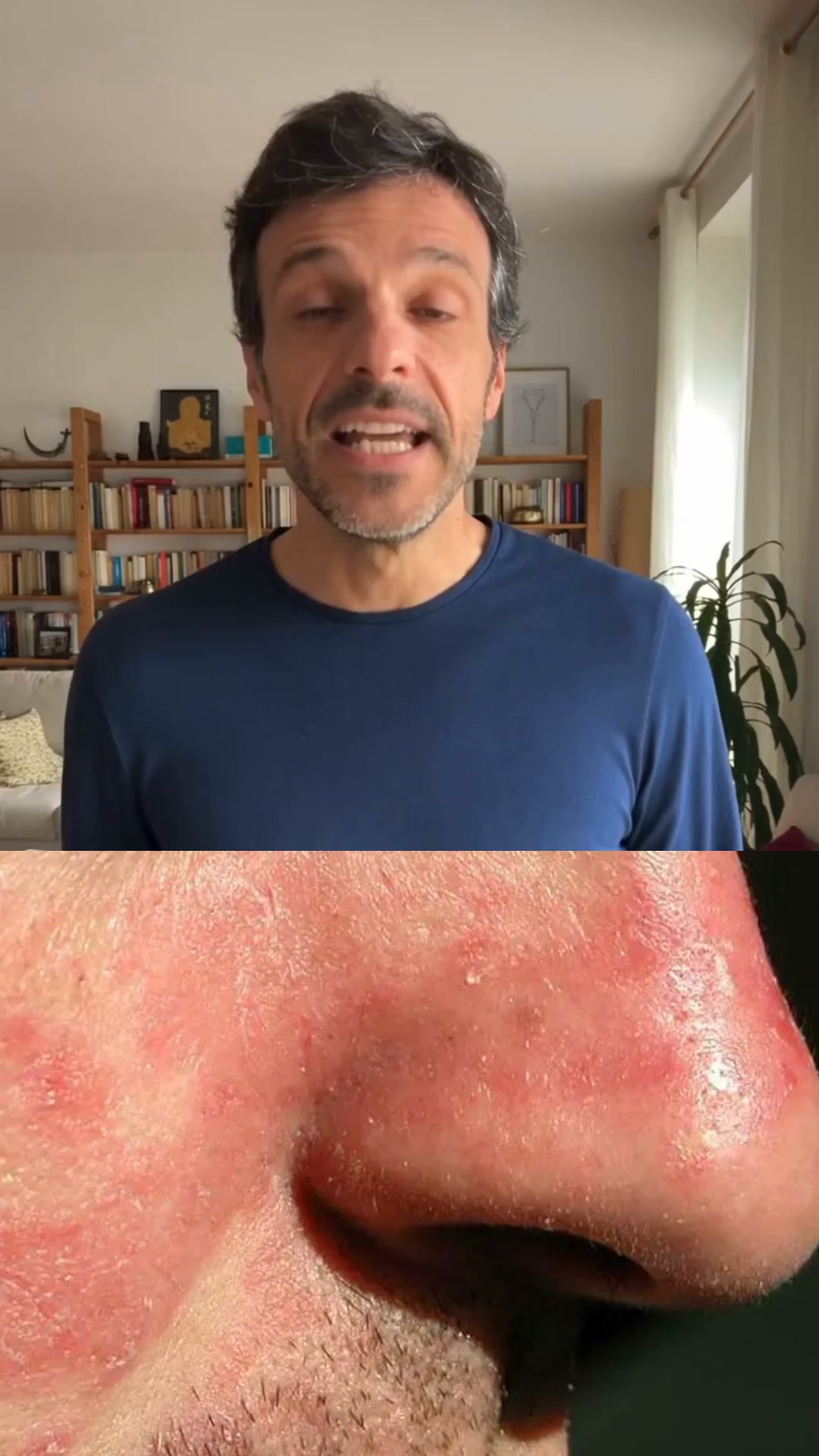 Supporto naturale per la tua Dermatite Seborroica
