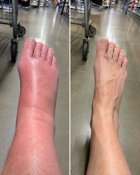 "12 years of edema swelling gone in 2 days?"