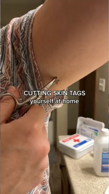 60% OFF Skin Tag Solution