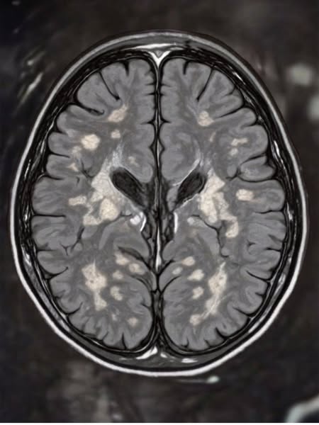 Un neuropsychologue explique ce qui aggrave vraiment le TDAH