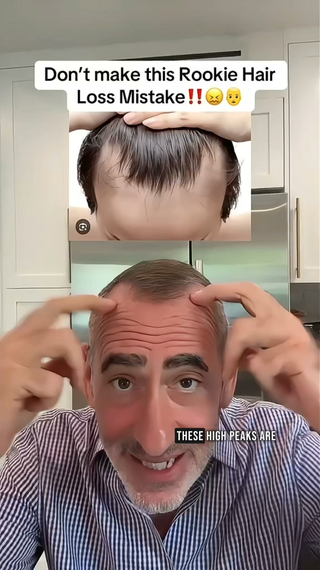 Bring back Your Hairline Naturally