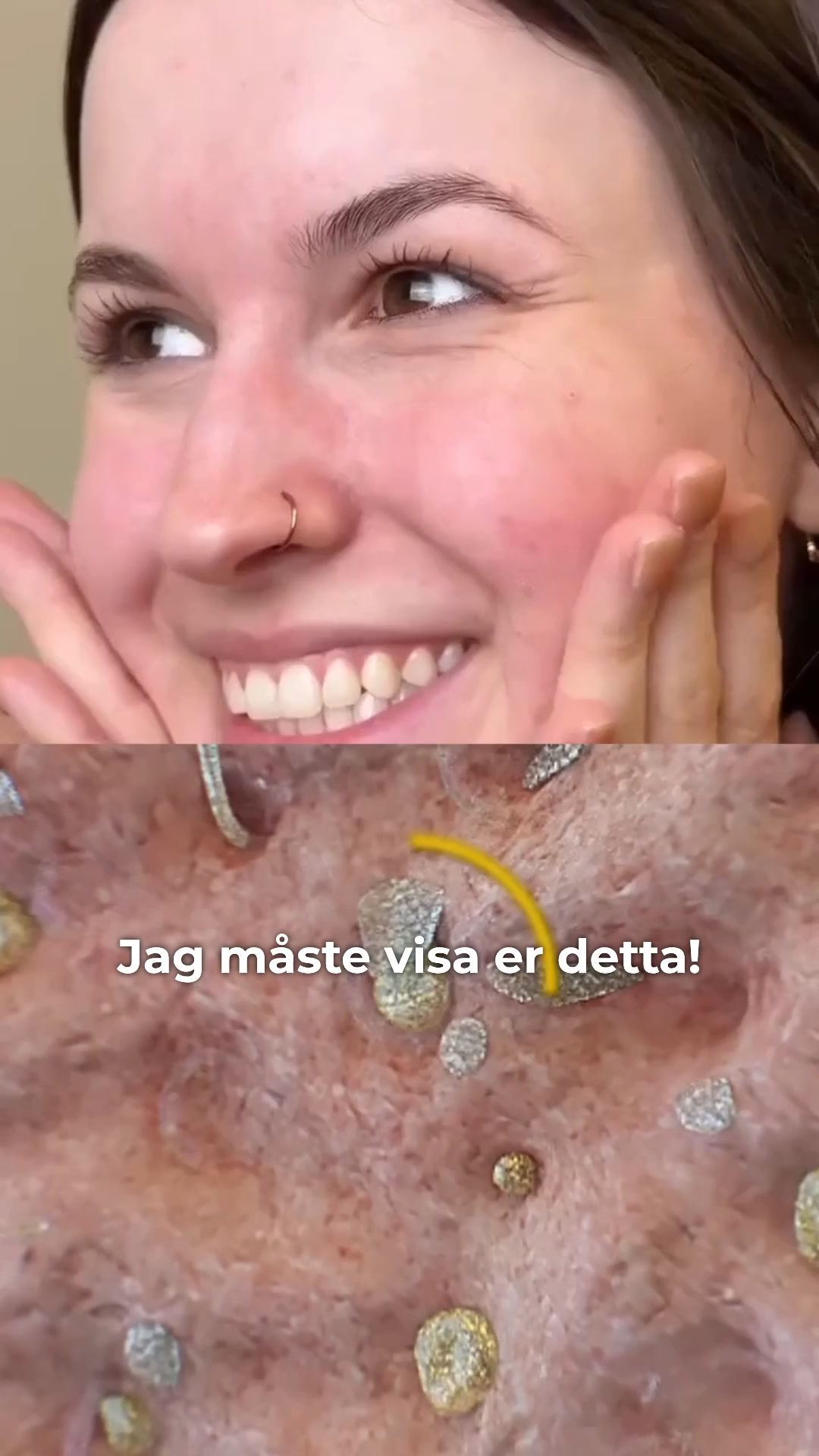Hejdå pormaskar, hej ren hud