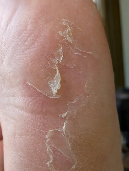 Eliminate Athlete’s Foot Today.