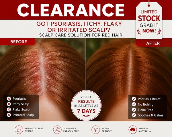 HEAL YOUR SCALP PSORIASIS in 10 Mins a Day