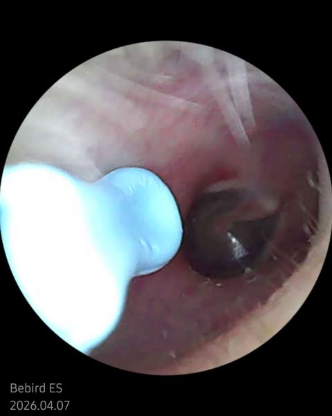 I Was Diagnosed With Eustachian Tube Dysfunction At 39. I'm 51 Now. My ENT Never Asked Me About The Headaches.