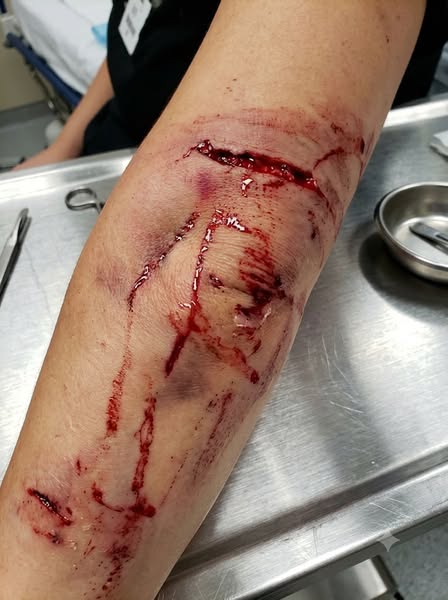 47 Nähte. 9 Monate auf Trazodon. Der Biss, den unser Verschreibungsprotokoll nicht verhindern konnte.