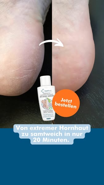 Lopalmed Hornhaut-Entferner ( 4,9/5)
