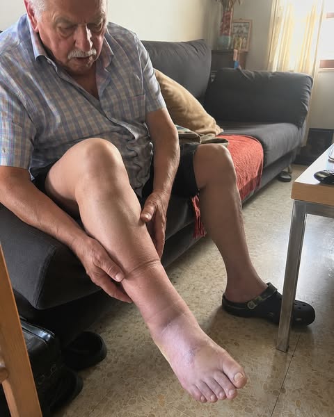 La hinchazón en las piernas...