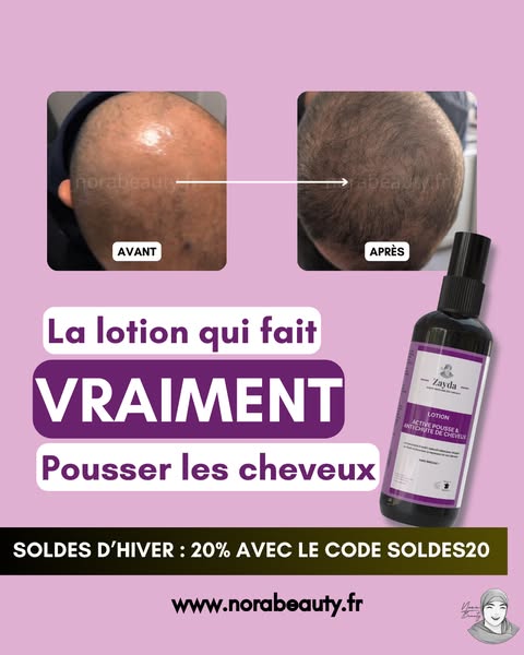 Calvitie : agir avant qu’il ne soit trop tard