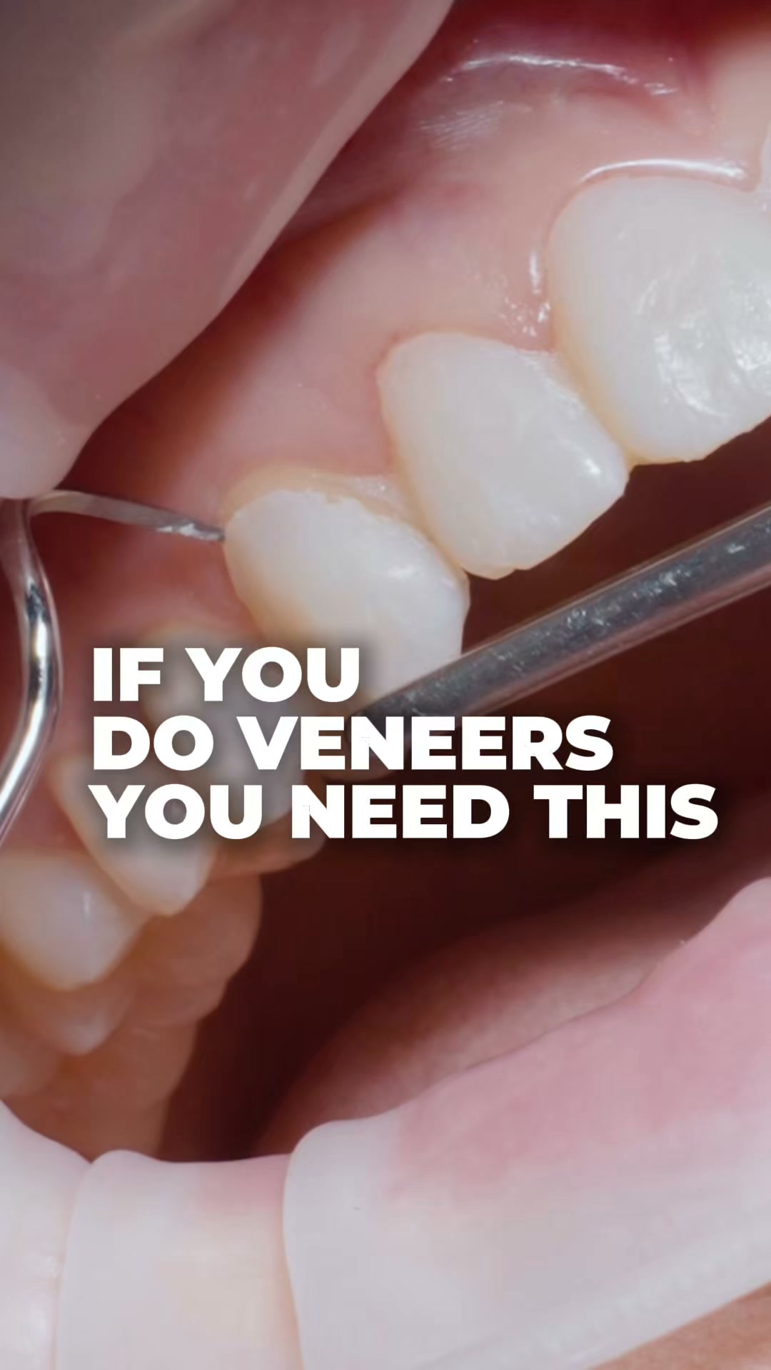 One Structured Veneer Workflow