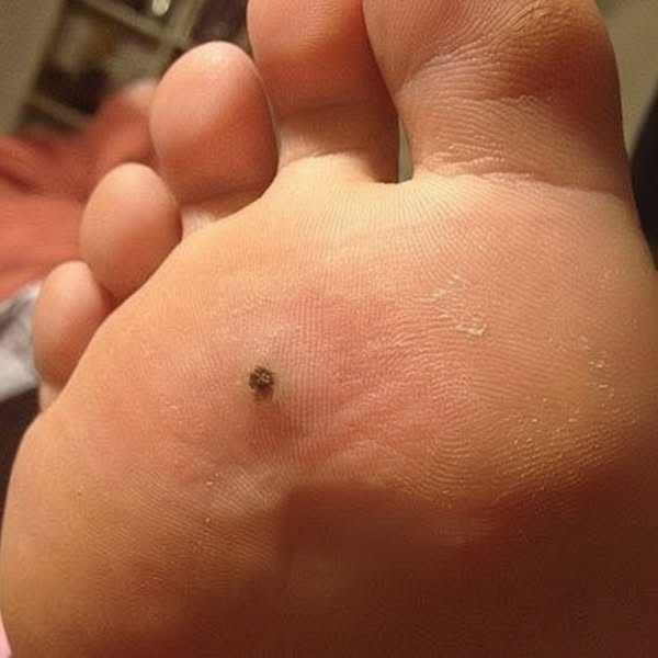 At Last — Relief for Burning Feet and Nerve Pain