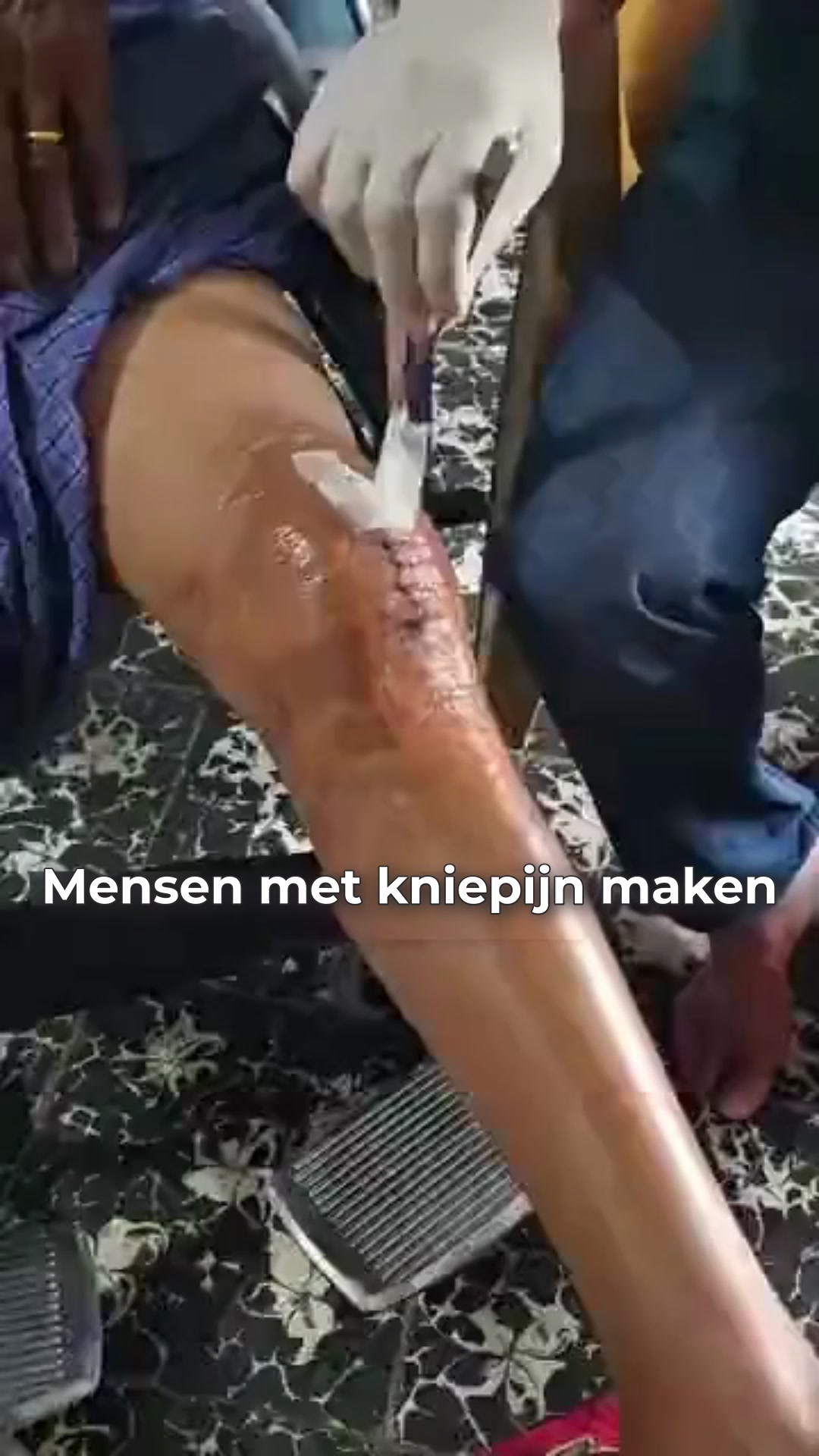 Kniepijn of artrose?