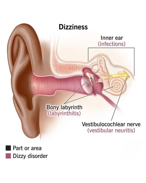 I Was Diagnosed With Vertigo At 46. I'm 58 Now. Turns Out The Dizziness Wasn't My Inner Ear.