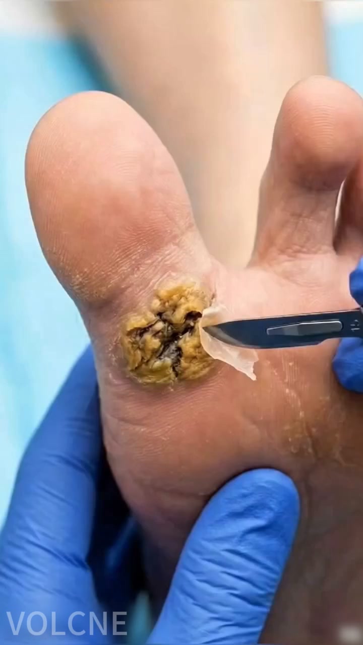SKAVIX™ Intensive Wart & Corn Remover Cream