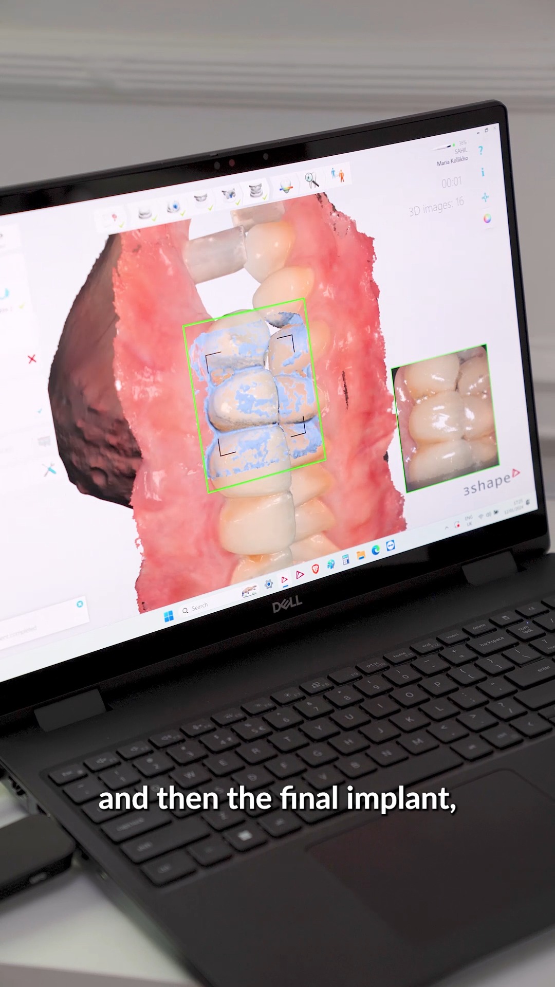 Premium Dental Implants From Just £2995! 15 Spots Only