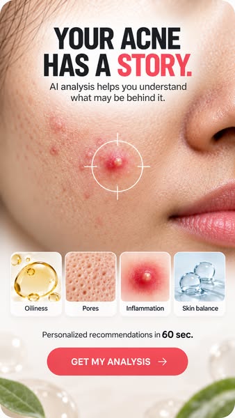 What’s Really Behind Your Acne?