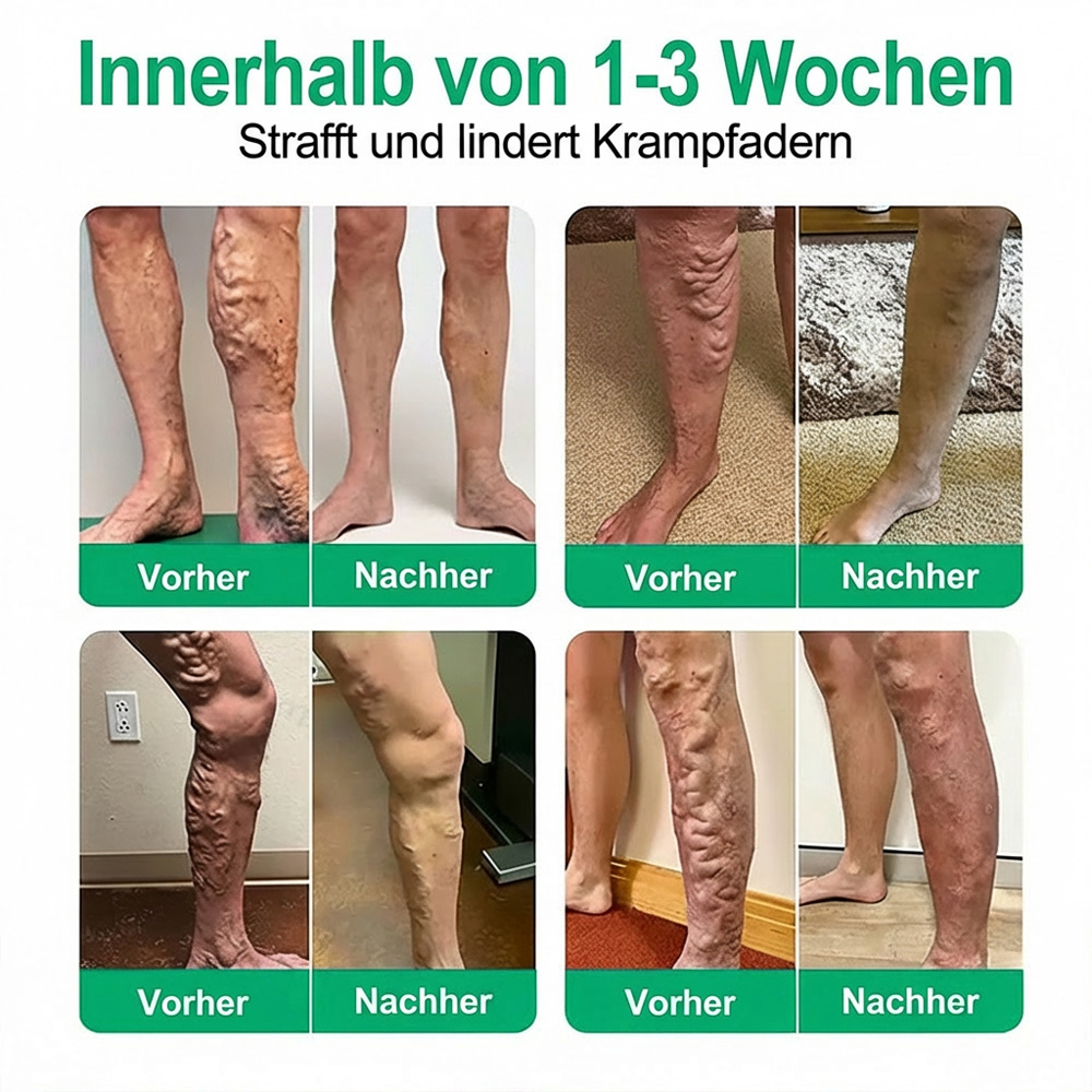 Sichtbare Krampfadern? Setzen Sie auf geprüfte Qualität.