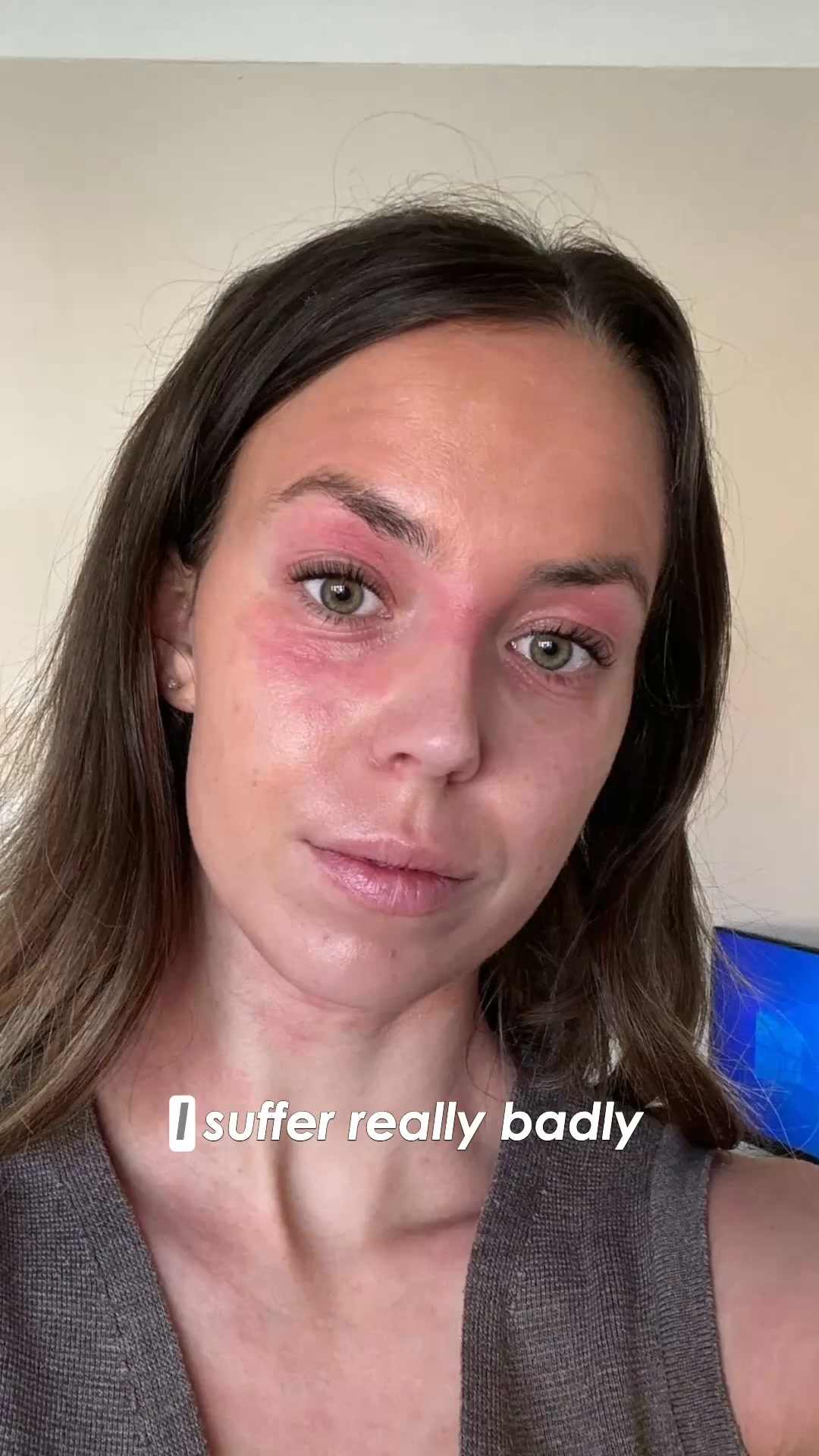 What's Causing Your Eyelid Eczema?