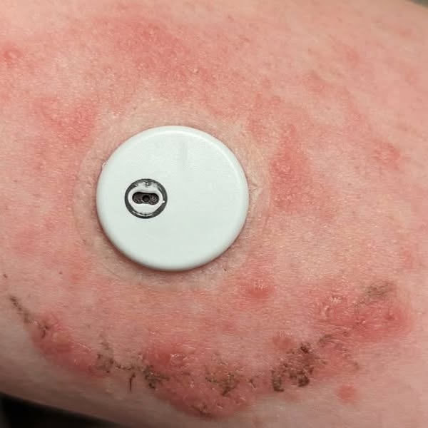 35 % der diabetischen Männer haben retrograde Ejakulation.