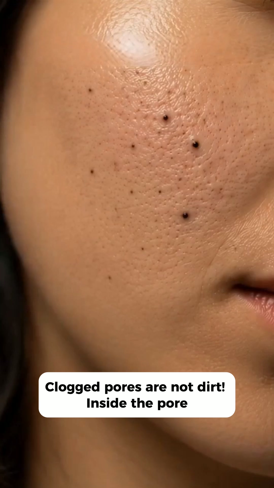 Eliminate Blackheads - Fast