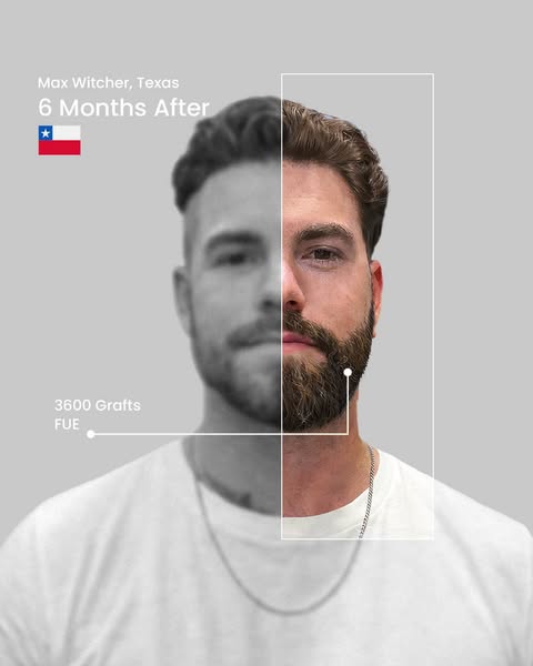 Hair Transplant in Turkey