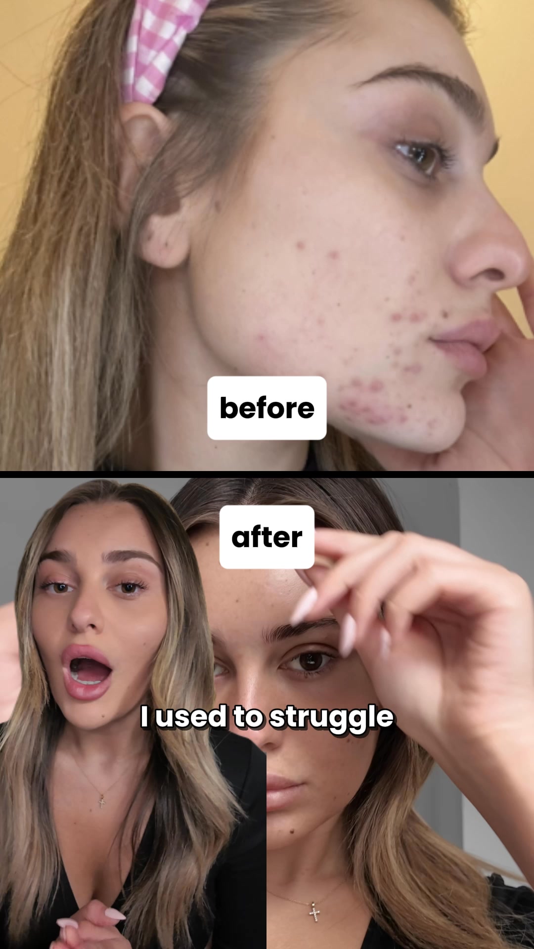 Clearer skin in 12 weeks