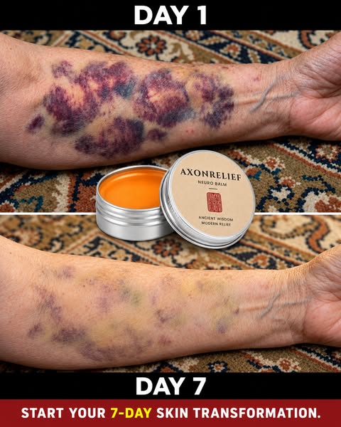 Senile Purpura Gone In Days
