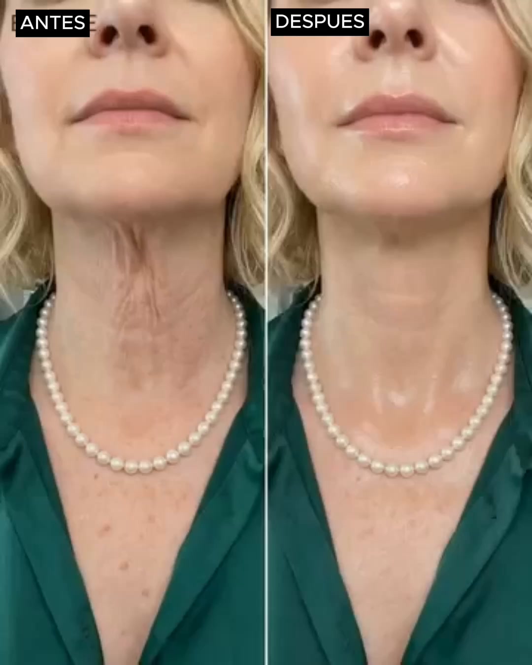 ¿Rostro firme, PERO cuello flácido?