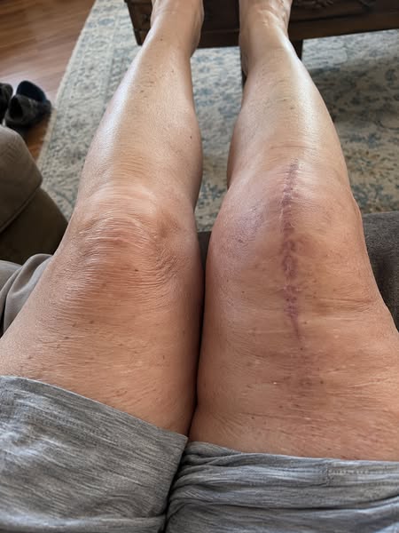 Stop Letting Knee Osteoarthritis Hold You Back