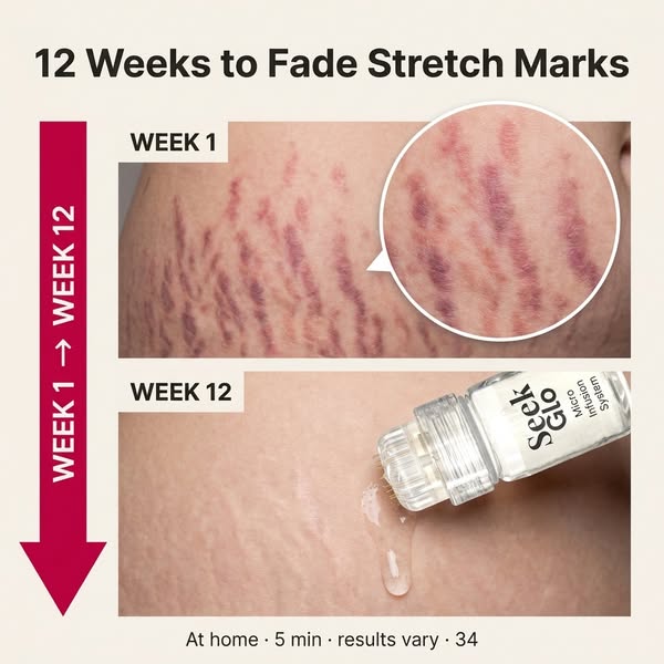 Stretch Marks? Try This At Home