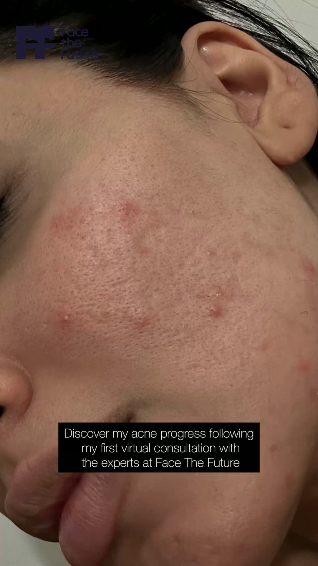 Kadeeja's Acne Journey