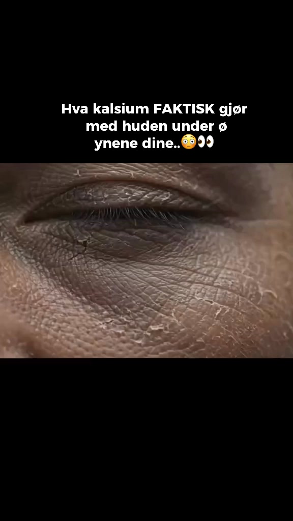 Ihosi ei kaipaa lisää kosteutta, vaan kalsiumia.
